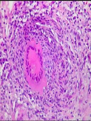 Productive type When fully developed, this lesion, a chronic granuloma, consists of three zones: (1) a central area of large, multinucleated