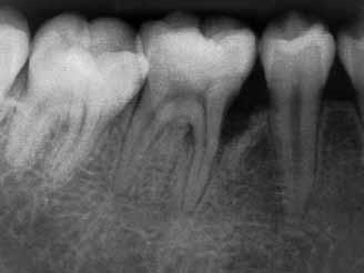 Compred with the originl sitution (), pronounced new one formtion mesil of the tooth