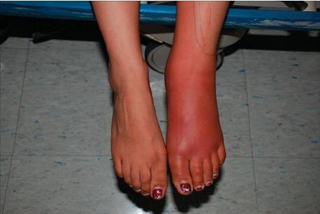 Purulent SSTI Non- purulent SSTI Recurrent SSTIs Overview 28 y/o woman presents with erythema of her lem foot over past 48