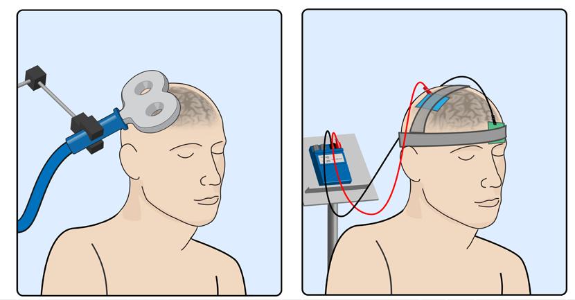 Noninvasive Brain Stimulation Transcranial Magnetic Stimulation (TMS)