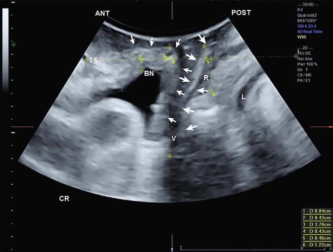 Mesh visualization using 3D transperineal ultrasound 461 was determined in relation to this line. The position of the mesh in relation to the bladder neck was measured craniocaudally (Figure 2).