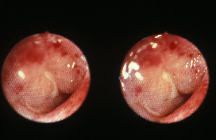 Colonoscopy Crohn