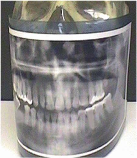 radiograph if you imagine the image layer to be bent around the patient s face Fig. 1.