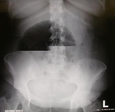 Figure 2 Figure 2: The erect plain x-ray abdomen showing air fluid level in the caecum. Figure 4 Figure 4: Intra operative photograph showing severely dilated caecum and mildly dilated small bowel.
