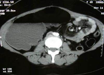 torsion demonstrating the bird beak sign. Diagnosis of caecal volvulus was established and after fluid resuscitation the patient was taken for laparotomy under general anesthesia.