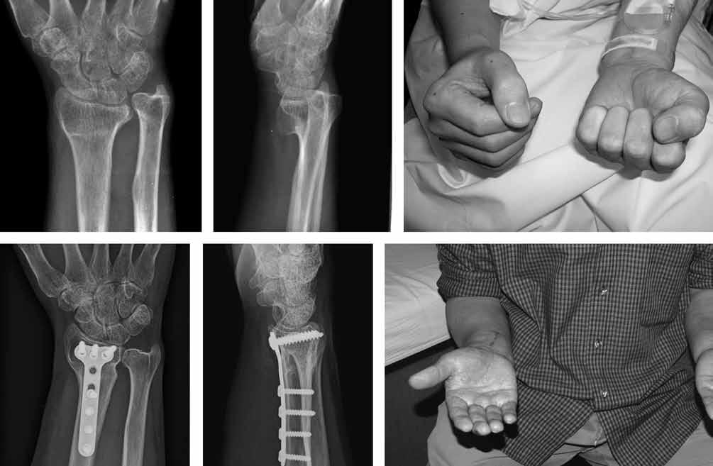 malunited radial FrACturES 177 A B C D E F Fig. 1. A 53-year-old man who had had a distal radius fracture, which was managed with a cast.