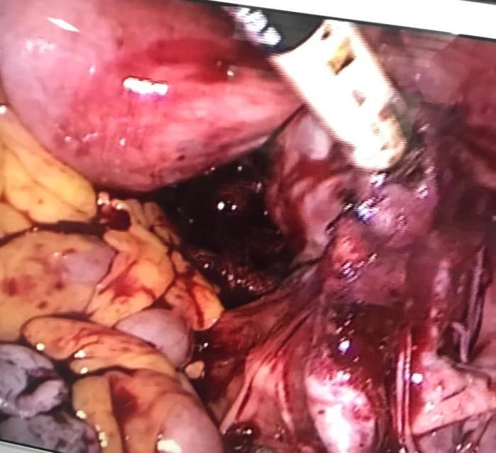 involves oophorectomy, salpingo-opherectomy, hysterectomy, excision of deep infiltrating endometriosis. In cases of involvement of bowel, resection may be required for complete cure.