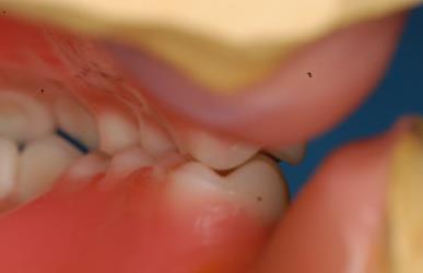 Any contact between teeth of opposing dental arches; usually, referring to contact between the occlusal surface.