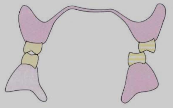 Balanced occlusion is done to obtain stability of denture during parafunctional movement.