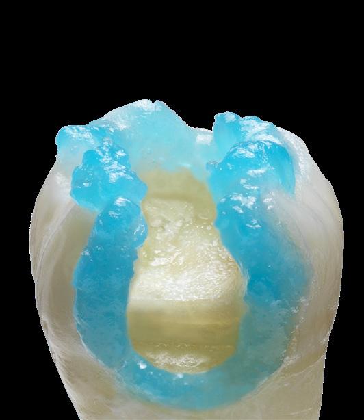 Selective-Etch adhesive virtually eliminates the risk of sensitivity on dentin by minimizing exposure to etchant.