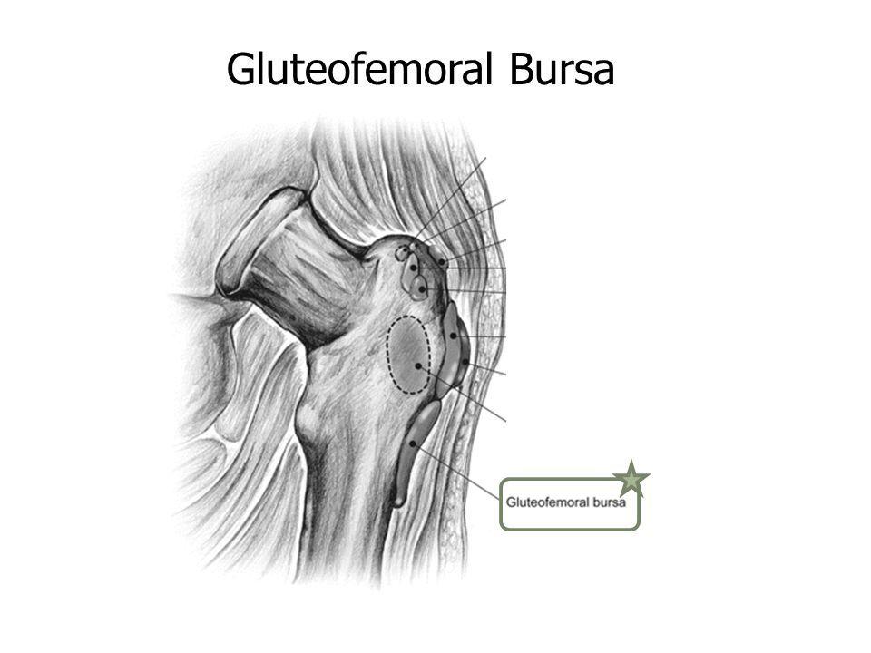 Bursae Gluteofemoral Bursa Separates gluteus maximus from superior part of