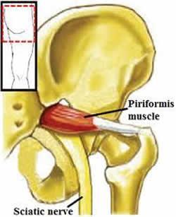 Muscles: Piriformis O: Anterior surface of lateral process of sacrum and gluteal surface of ilium at the margin of the greater sciatic notch I: Superior border of greater trochanter A: Laterally