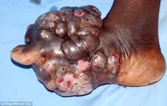 The diseases they cause include sporotrichosis, chromoblastomycosis, and mycetoma.