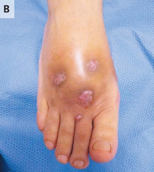 Chromoblastomycosis and mycetoma are clinical syndromes with multiple fungal etiologies.