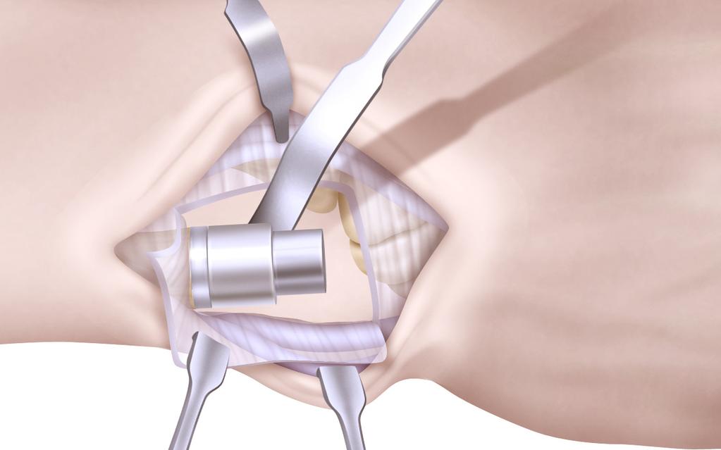 Remove the osteotomy guide and reamer, and complete the osteotomy. Step 8: Trial Reduction Choose the stem trial that corresponds to the last reamer used. Figure 7A.