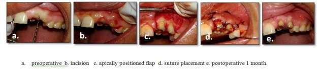 internal bevel incision was given and a full thickness flap was reflected.