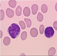 MANTLE CELL LYMPHOMA