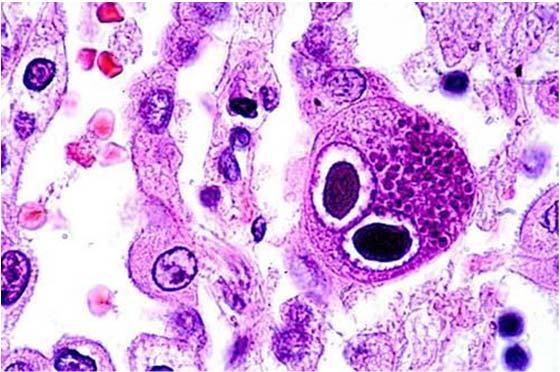 CMV Infection in Organ Transplantation CMV cytopathic effect CMV infection leads to death of infected cells Fishman JA, Rubin RH. NEJM 1998 www.pathologyoutlines.