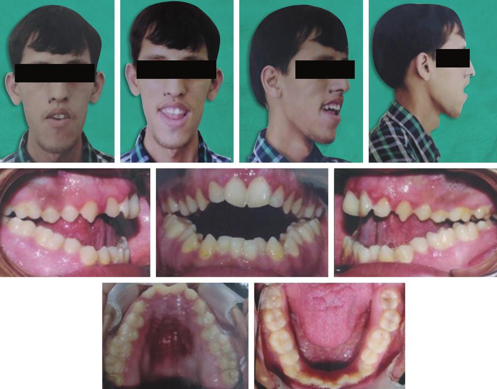 Vinni Arora, et al. Figure 1 Pre-treatment Photographs Figure 2 Panoramic Radiographs dontic camouflage with premolars and molars extraction, chincup and orthognathic surgery.