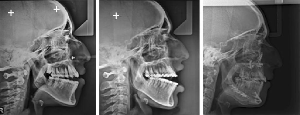 Ortho-surgical Management of Severe Vertical Dysplasia: A Case Report Figure 3 Lateral Cephalograms Figure 4 Presurgical Photographs 2.