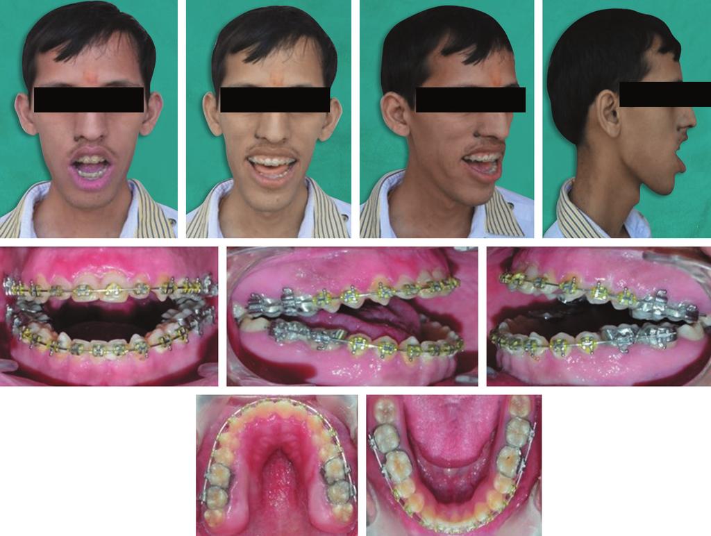 skeletal open bite patients with excess vertical maxillary growth. In our case a 5 mm maxillary superior impaction was done.