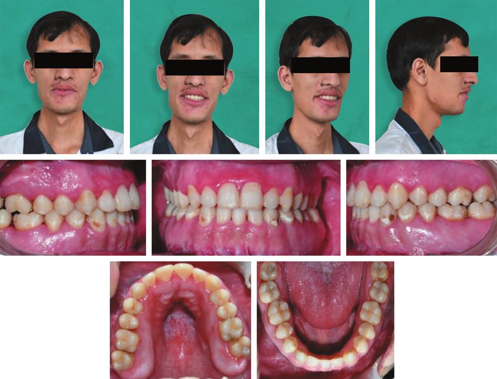 Ortho-surgical Management of Severe Vertical Dysplasia: A Case Report Figure 6 Post-debonded Photographs have shown that orthodontic-surgical correction of open-bite malocclusion has greater