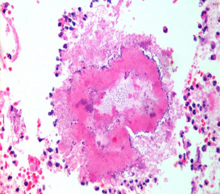 Answer to photo quiz Histopathology showed lung parenchyma with cavity lined by necrotic material surrounded by neutrophils, lymphocytes, plasma cells and histiocytes.