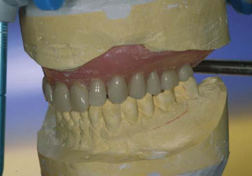 the removable acrylic prostheses, with a large mucosal support, that is necessary to obtain adequate stability, and precision in repositioning during the following trials (Fig. 4).