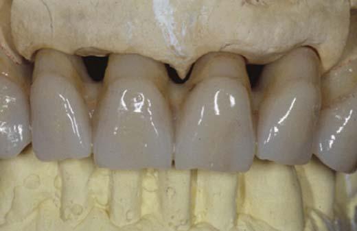 Set-up with acrylic resin teeth Special attention, in order to collect preliminary information, must be put on gips models, pictures, X-rays, and on a careful evaluation of intra and extra oral soft
