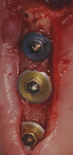 9. Rubber dam to separate acrilic resin from surgical wound Fig. 7.