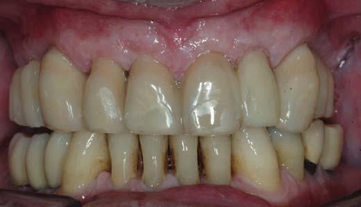 The final impression is realised with a custom made tray and screw retained pick-up transfers (2). Fig. 11. Provisional positioned after checked occlusion.