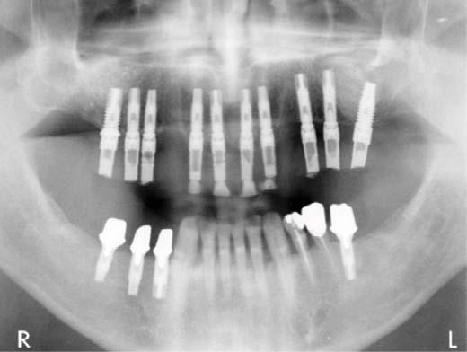 Four hours from the starting; flapless surgical technique was used in the frontal incisors Fig. 14a. Occlusal view: all implants are osteointegrated Fig. 13.