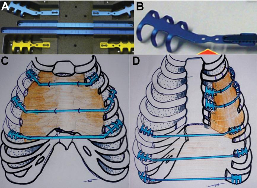 GENERAL THORACIC 1710 BERTHET ET AL Ann Thorac Surg INNOVATIVE CHEST WALL RECONSTRUCTION 2011;91:1709 16 Fig 1. Strasbourg thoracic osteosynthesis system (STRATOS). (A) Rib clips and connecting bars.