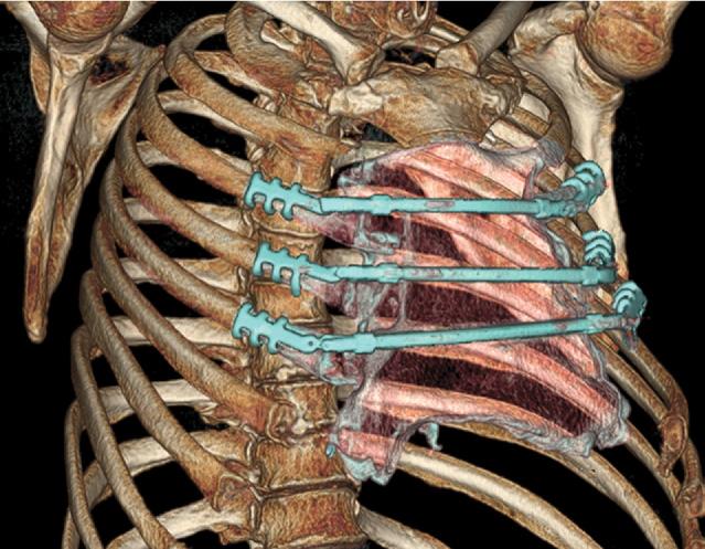 To reestablish the rigidity of the thoracic wall, we used the STRATOS to bridge the defect.