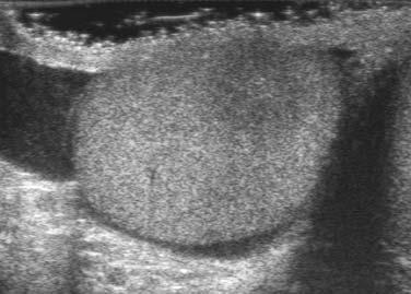 Focal orchitis US poorly defined,