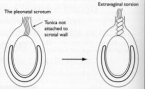 Testicular torsion Intravaginal torsion :