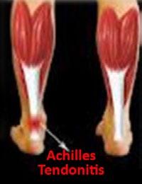 Achilles Tendinitis 101 Achilles Tendinitis Causes: Persistent strain on the achilles tendons causes irritation and inflammation. In severe cases this strain may even cause the tendon to rupture!