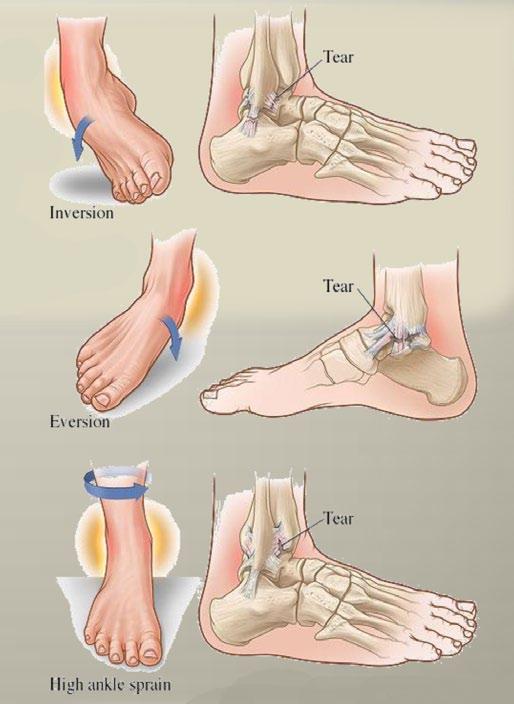 Ankle Sprain 101 Ankle Sprain Causes: Ankle sprains happen wheter you participate in sport or not.