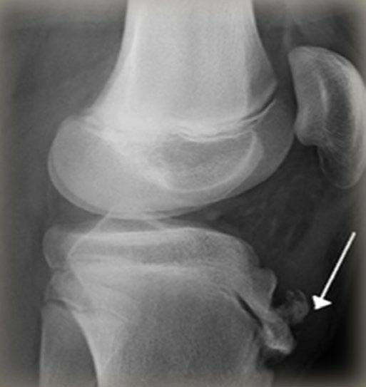Osgood Schlatter Disease 101 Osgood Schlatter Causes The patella tendon inserts at the tibial tuberosity and through overuse can tug away at the bone causing inflammation.