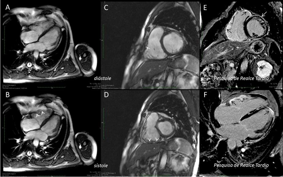 668 Int J Cardiovasc Sci. 2018;31(6)667-671 Diastole Late enhancement analysis Systole Late enhancement analysis Figure 1 - Cardiac magnetic resonance imaging.