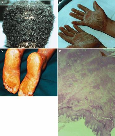 ARVD: NAXOS DISEASE Figure 1. A, WH as a feature of Naxos disease (non-african ancestry). B and C, Palmar and plantar keratoderma.