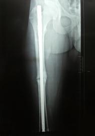 Fracture is considered ununited after six months of primary nailing.