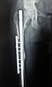 of axis deviation, rigid internal fixation with compression of the, which all optimize the conditions for bone healing.