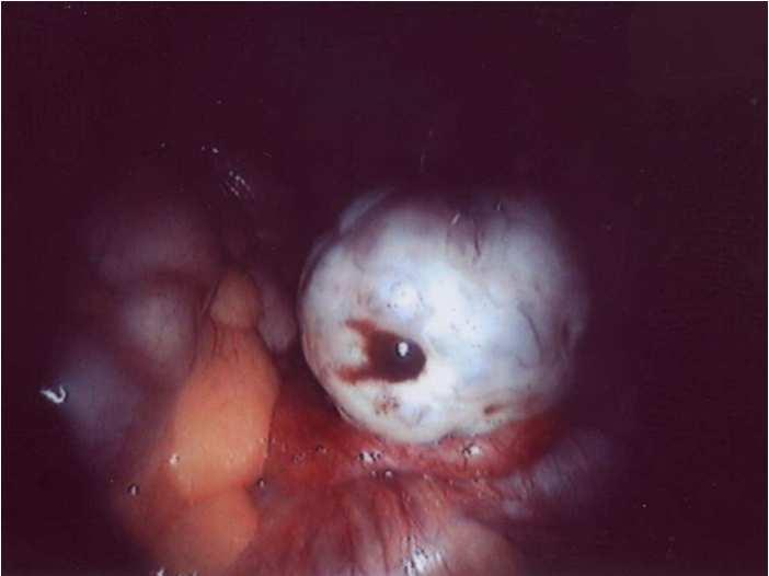 antibodies Endometriosis Only by laparoscopy Minor difficult to understand how fertility affected possible role for ovulation or peritoneal fluid Severe adhesion formation