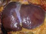 Cirrhosis Pronounced sir-o-sis Means scarring of the liver At risk for liver failure