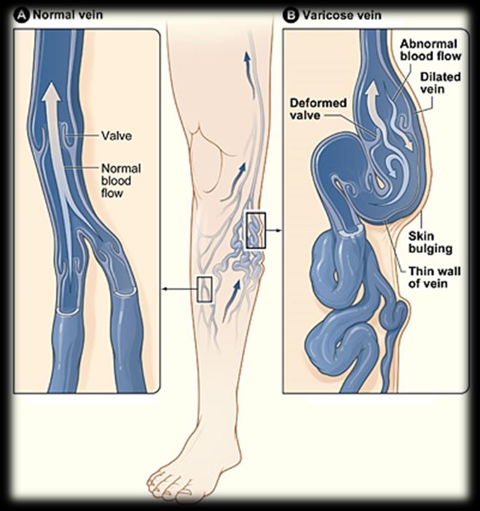 Varicose Veins Primary hereditary Secondary post DVT Recurrent post surgery or sclerotherapy Types Trunk (thick knobbly veins) Reticular (network of