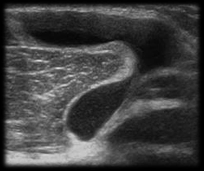 Synovial cyst Lined by synovial tissue Communicate