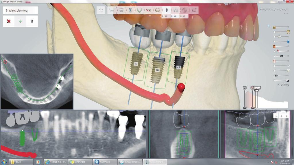 3D Computer based treatment planning It is accurate Every patients has different bone sizes and structures.