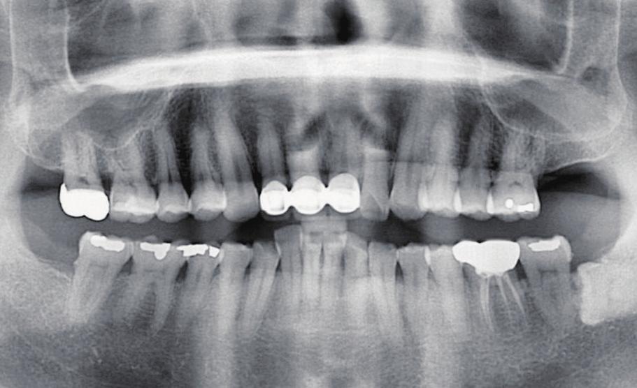 Upper molar area treatment through sinus