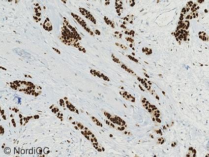 3a Optimal ER staining of the breast ductal carcinoma no. 4 with 90-100% cells positive using same protocol as in Fig. 1a.